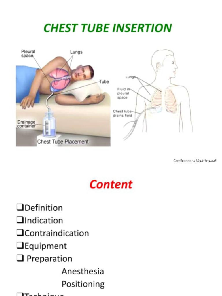 Chest Tube Insertion | PDF