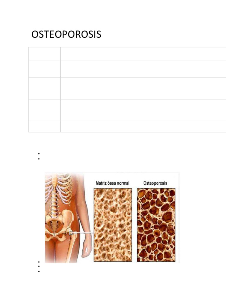 Guía Completa sobre Osteoporosis | PDF | Osteoporosis | Hueso