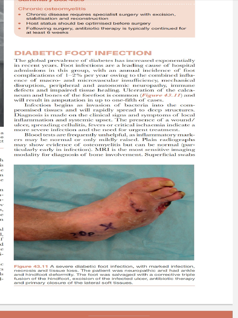 Diabetic Foot Ulcer | PDF