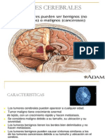 13 Tumores Cerebrales