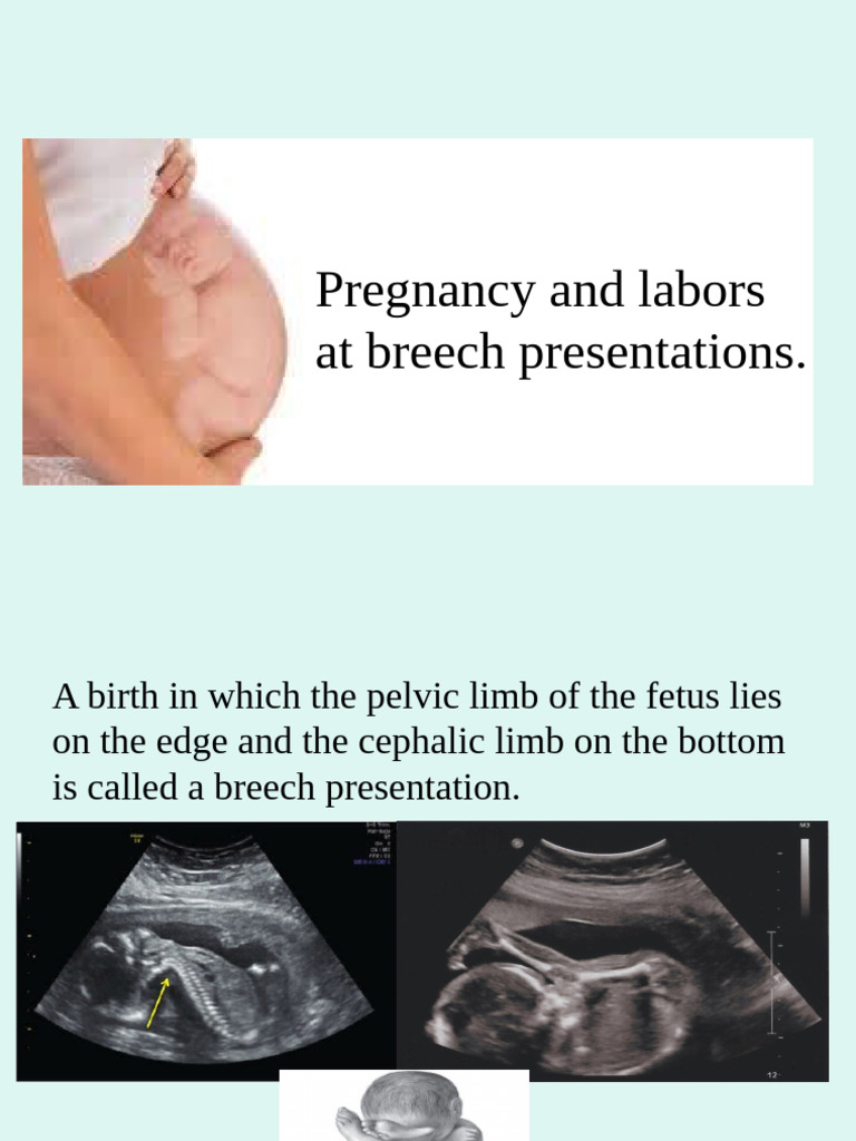 Understanding Breech Presentations in Labor | PDF | Pelvis | Hand