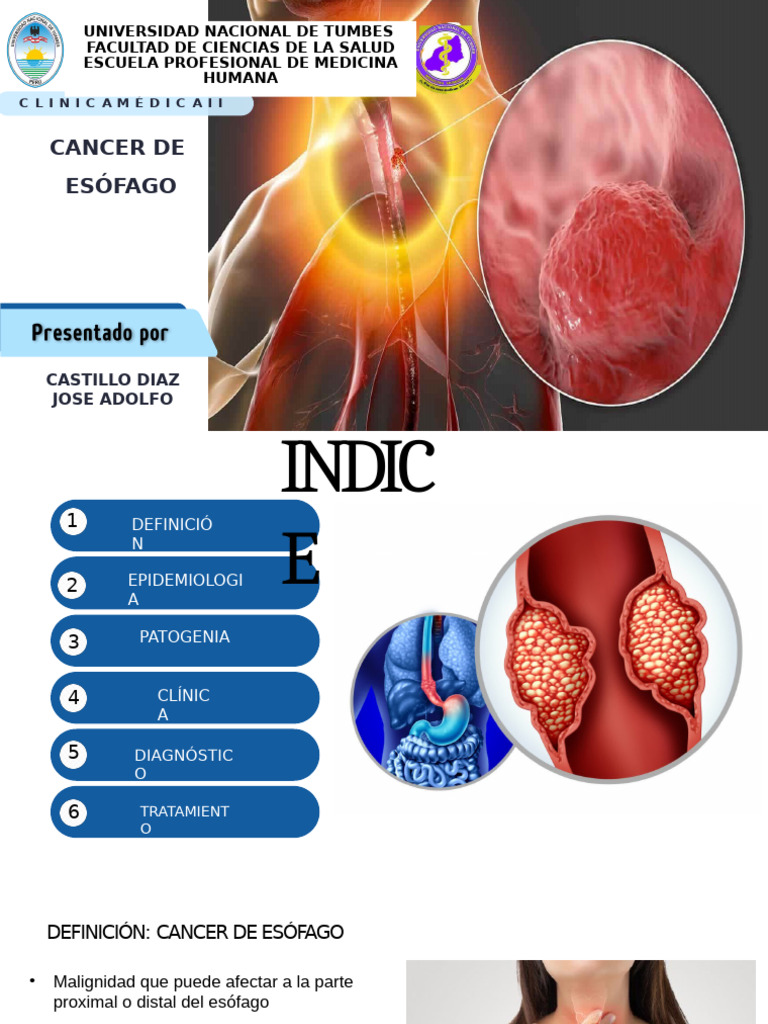 Càncer de Esòfago. | PDF | Cáncer de esófago | Cáncer