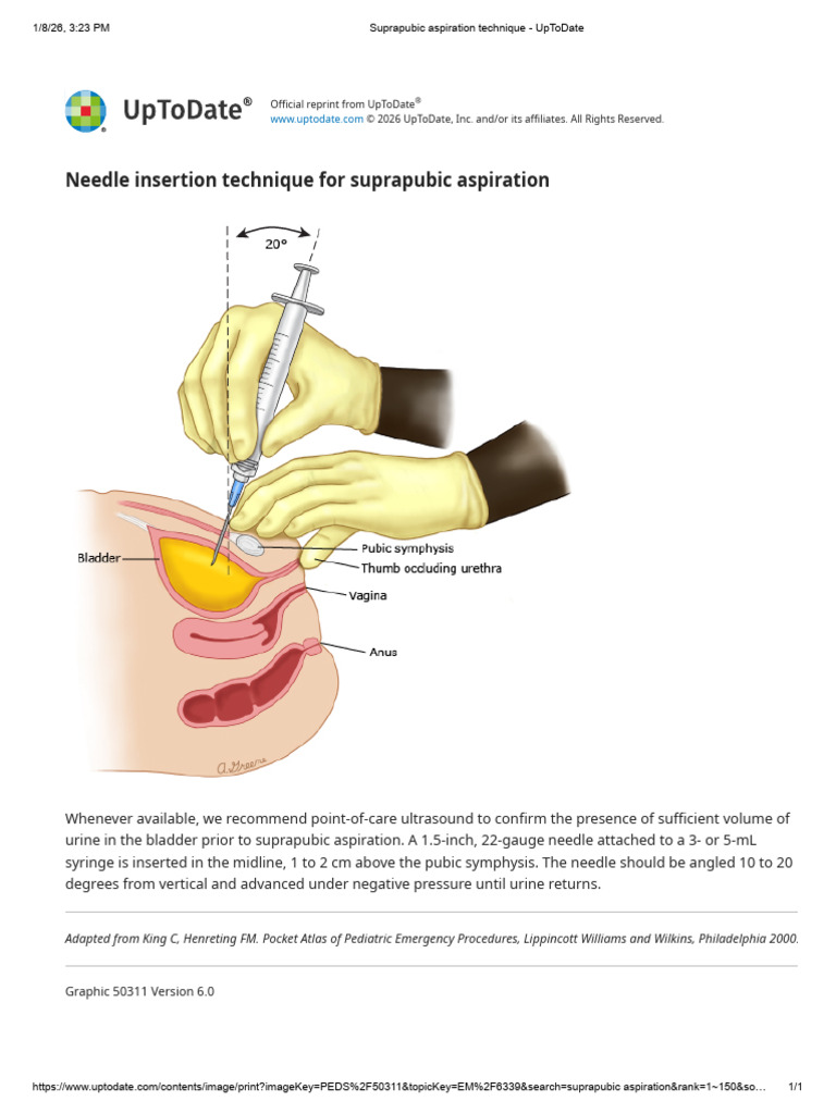 Suprapubic Aspiration Technique - UpToDate | PDF