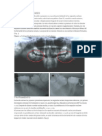 Premolar Retenido Por Lingual Reporte