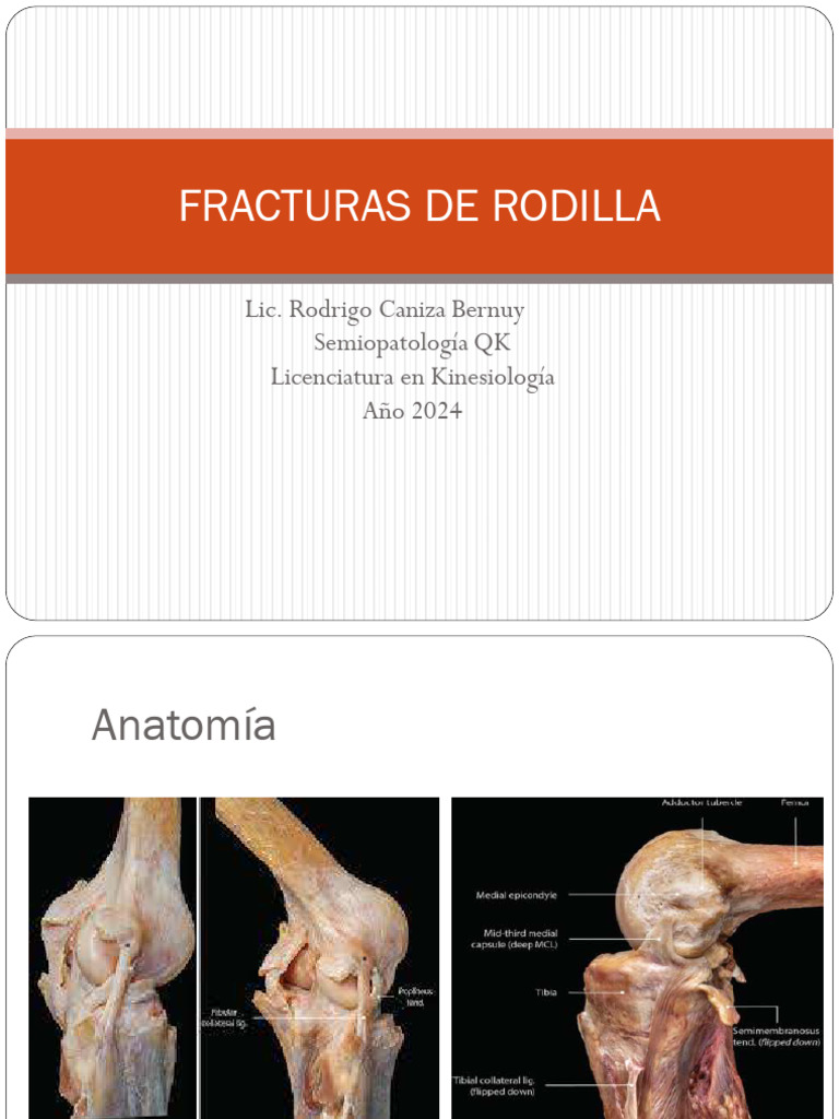 Fracturas de Rodilla: Tipos y Tratamientos | PDF | Rodilla | Sistema ...