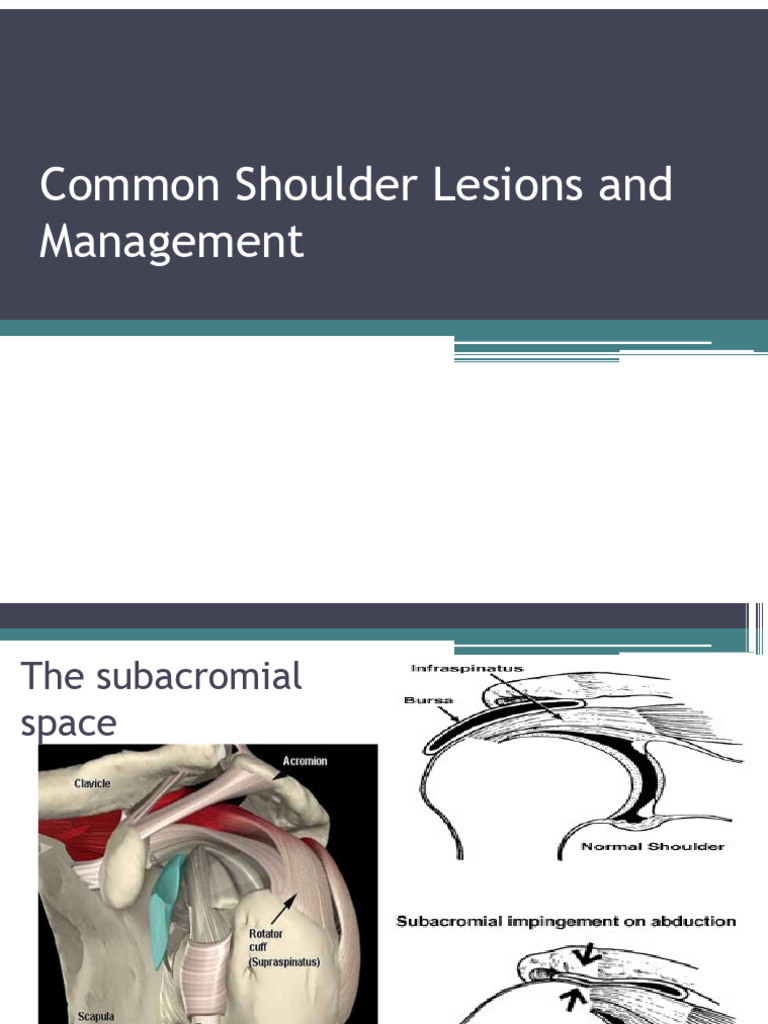 Shoulder Lesions: Types and Treatments | PDF | Shoulder | Human Anatomy