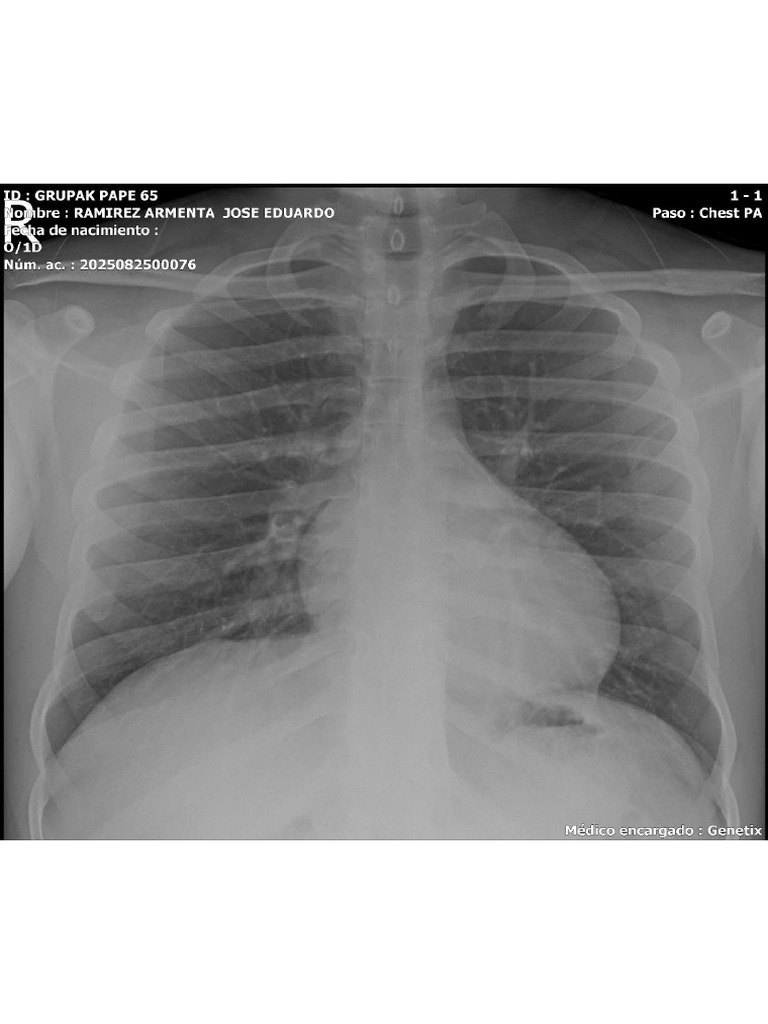 Radiografía de Tórax Normal - Informe Médico | PDF | Tórax | Medicina ...