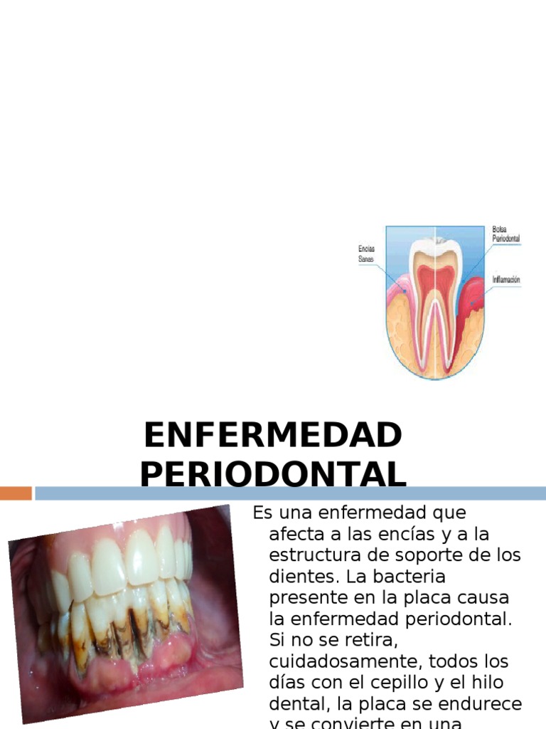 Enfermedad Periodontal | PDF | Diente humano | Odontología
