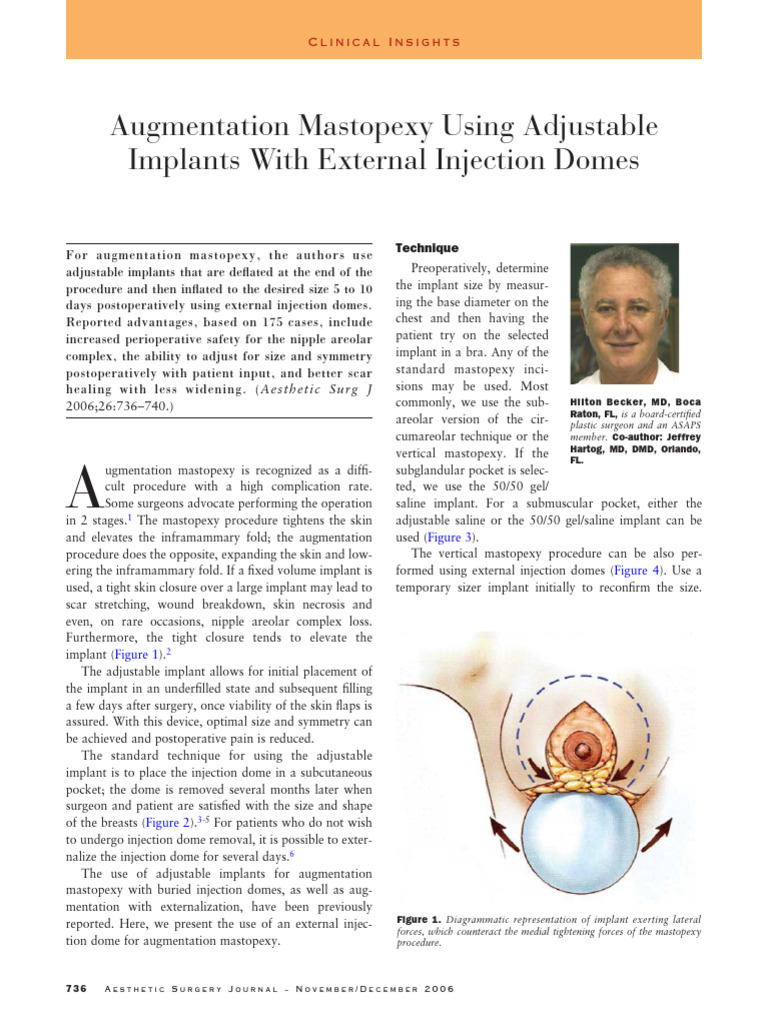 Augmentation Mastopexy Using Adjustable | PDF | Organ (Anatomy) | Surgery