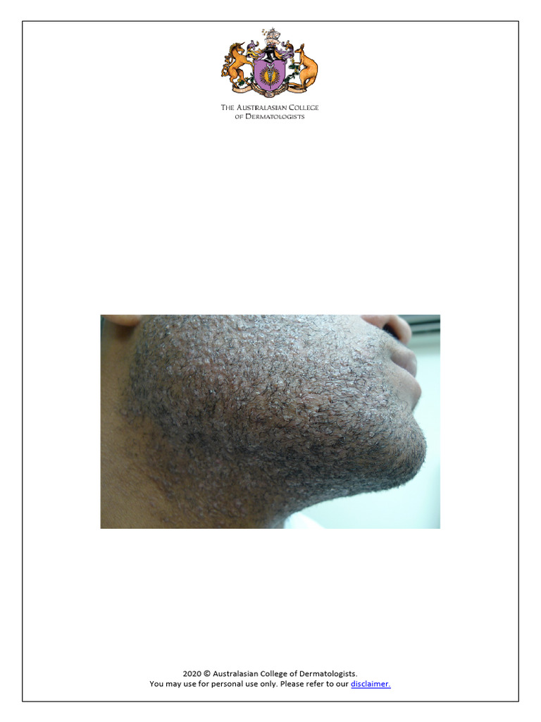 Pseudofolliculitis Barbae A Z of Skin 1 | PDF | Shaving | Medical ...