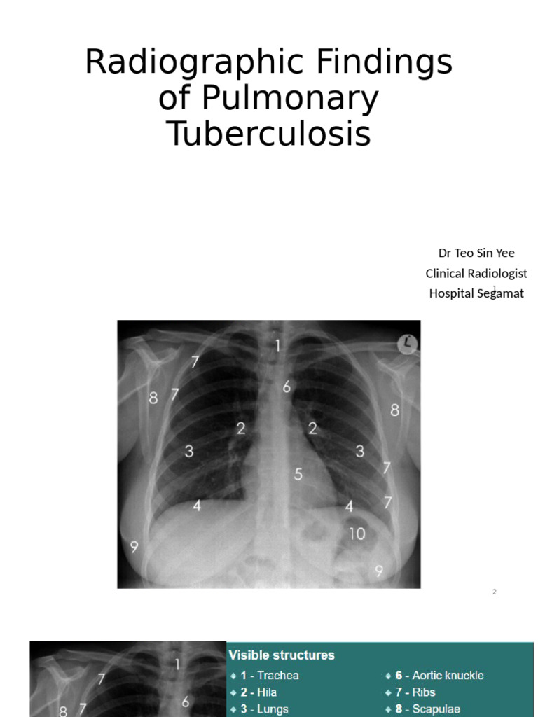 Radiographic Insights on Pulmonary TB | PDF | Tuberculosis | Lung