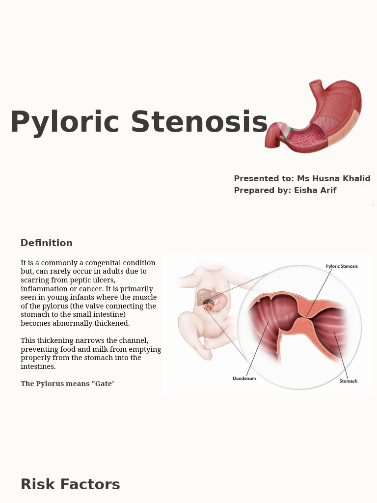Pyloric-Stenosis-Editedpptx | PDF