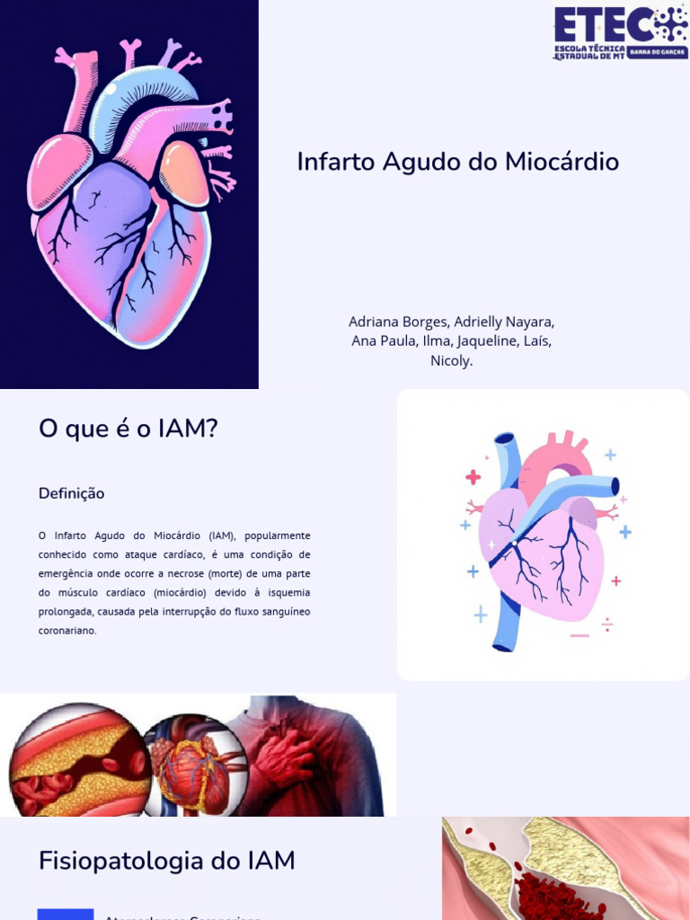 Infarto Agudo do Miocárdio: Causas e Tratamento | PDF | Infarto do ...