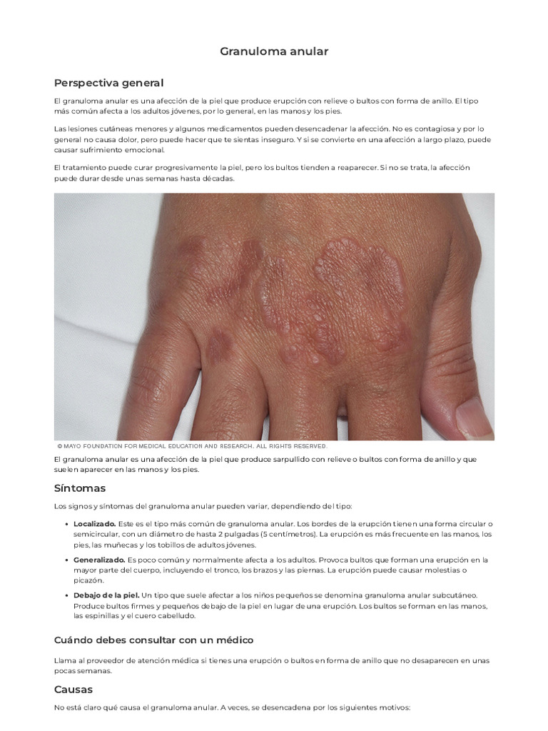 Granuloma Anular S ntomas Y Tratamientos PDF C ncer Enfermedades 