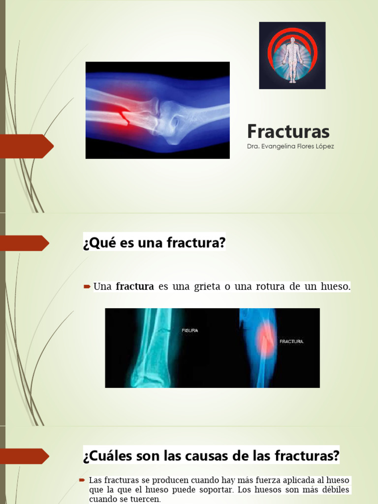 Guía Completa sobre Fracturas y Tratamientos | PDF | Hueso | Osteoporosis