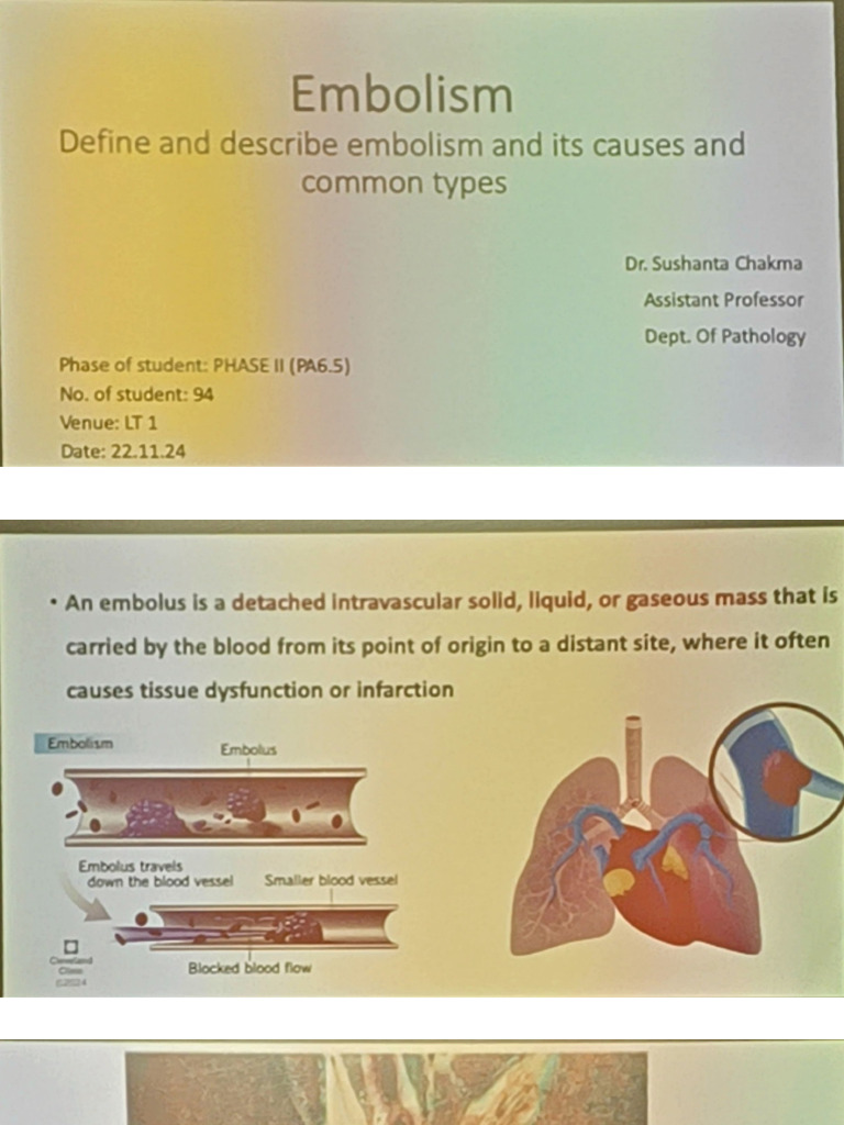 Embolism | PDF