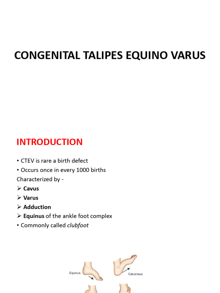 Congenital Talipes Equino Varus | PDF | Foot | Ankle