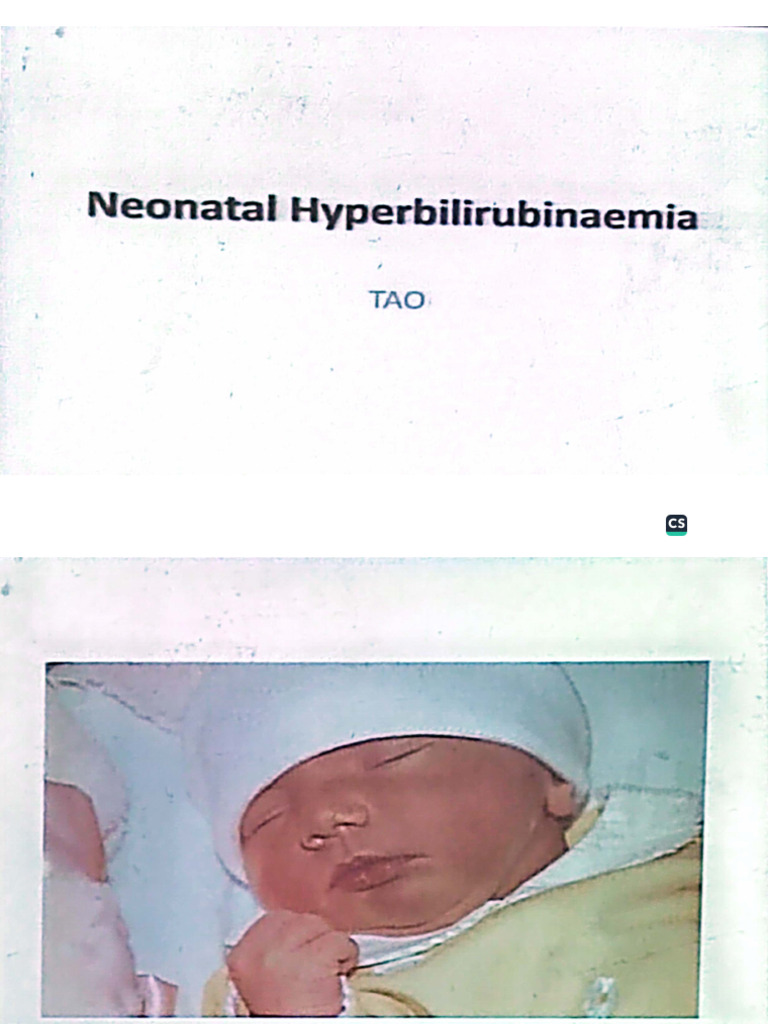 Neonatal Hyperbilirubinaemia | PDF