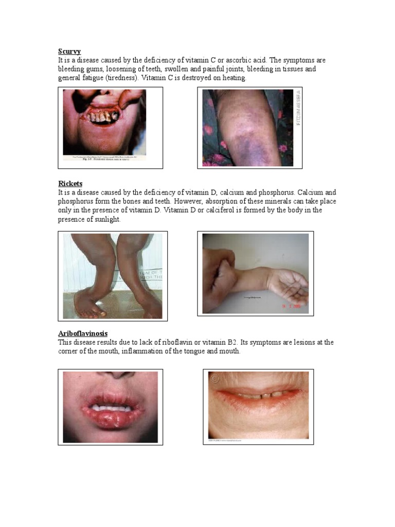 vitamin c deficiency symptoms lips Here's how to tell whether your dry lips signal a nutrient deficiency and  how to find relief: https://bit.ly/4eOarBl main image 0