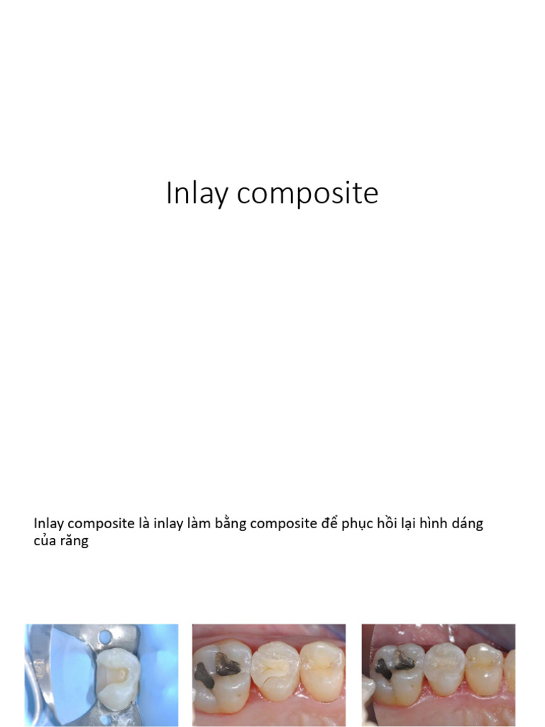 Inlay Composite | PDF