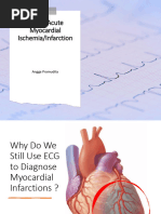 Right Ventricular Infarction ECG Guide | PDF | Myocardial Infarction ...