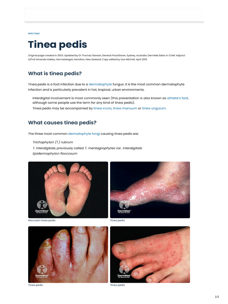 Tinea Pedis (Fungal Foot Infection) | PDF | Human Diseases And ...