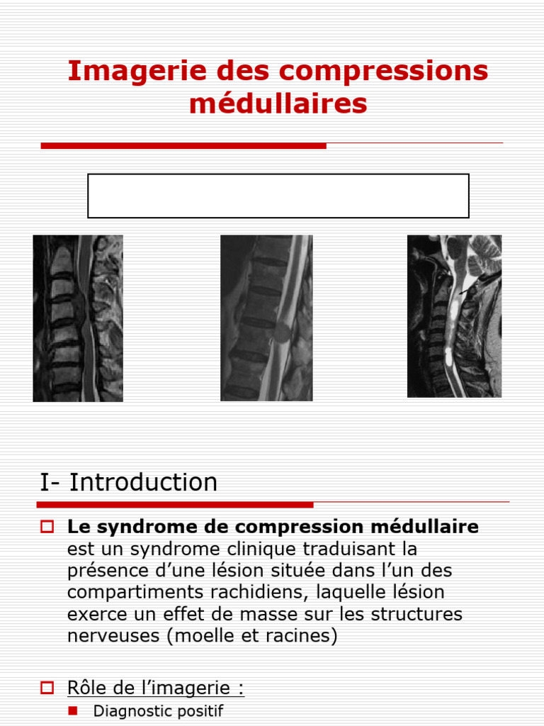 6 - Les Compressions Médullaires | PDF | Moelle épinière | Spécialités ...