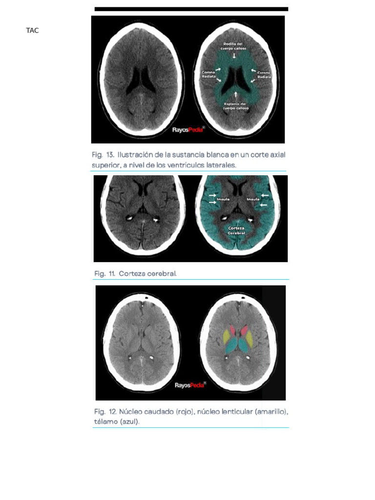 TAC Cerebro Basioco | PDF