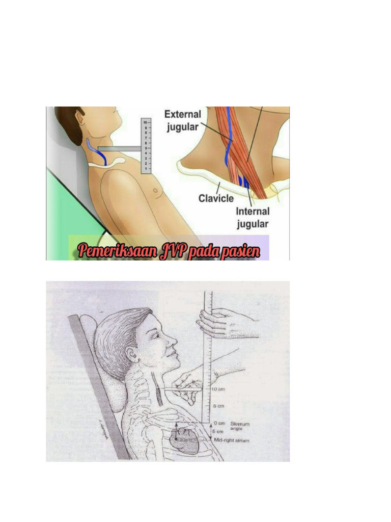 Gambar Ukur JVP | PDF