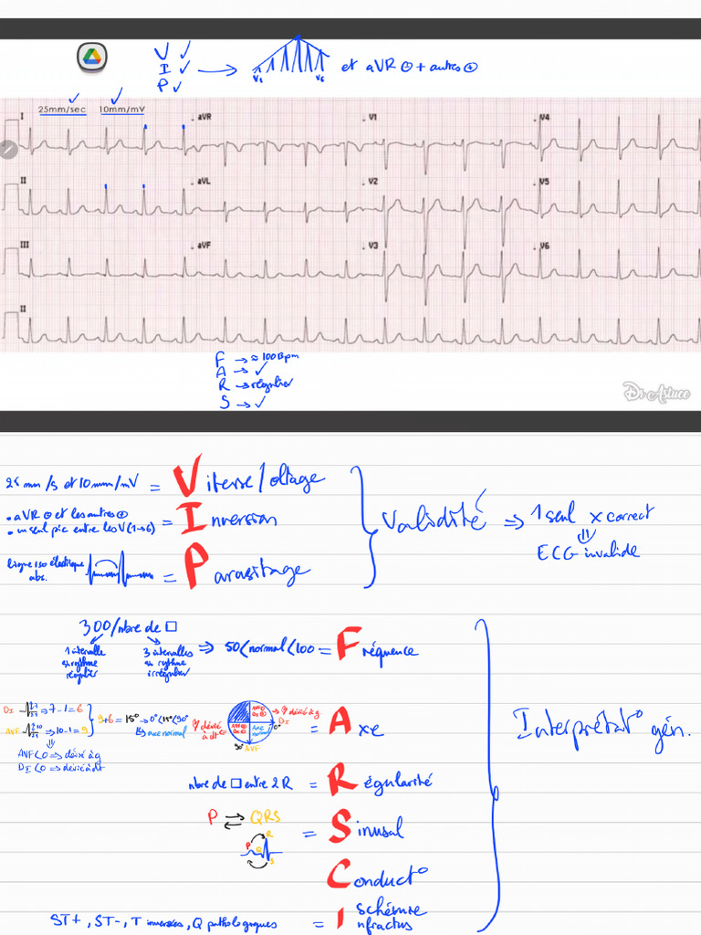 Notes ECG - 250615 - 123448 | PDF