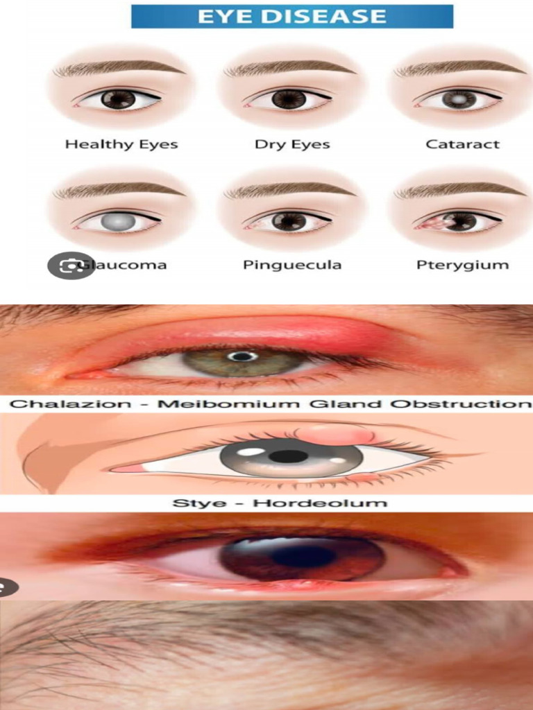 EYE | PDF