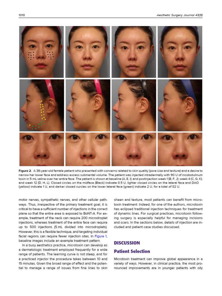 A B C D: Aesthetic Surgery Journal 43 | PDF | Syringe | Clinical Medicine