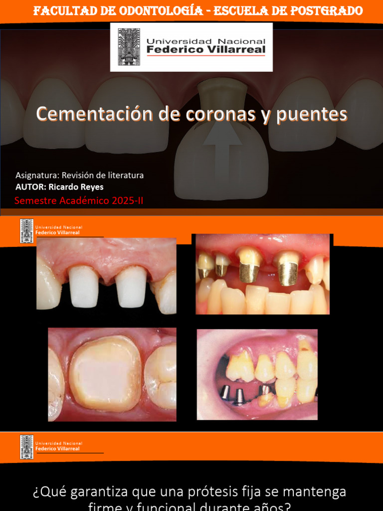 Cementación de puentes y coronas | PDF | Cemento | Adhesión
