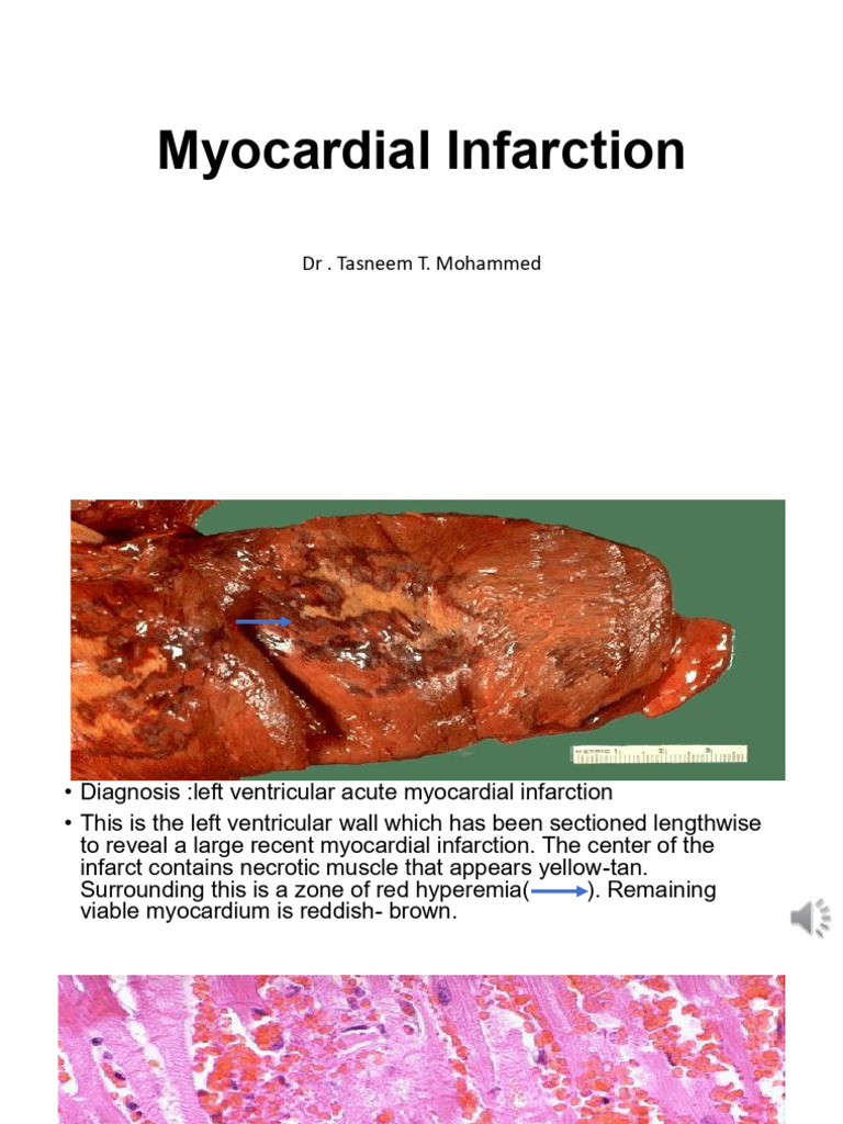 Infarction | PDF