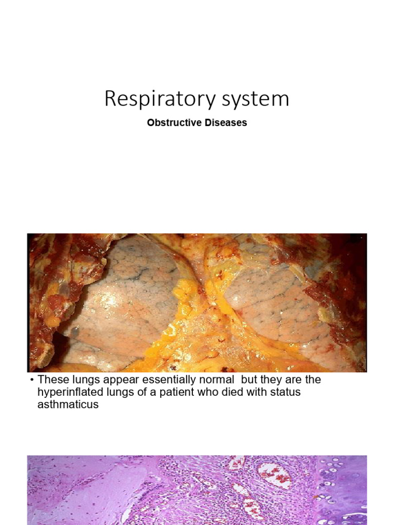 Respiratory System: Obstructive Diseases | PDF