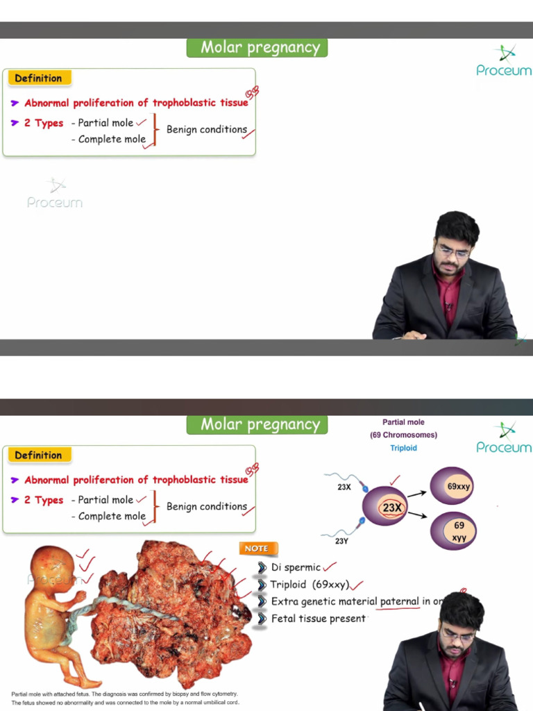 Molar Pregnancy | PDF