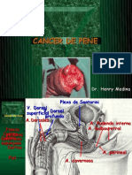 CANCER DE PENE: TRATAMIENTO Y COMPLICACIONES