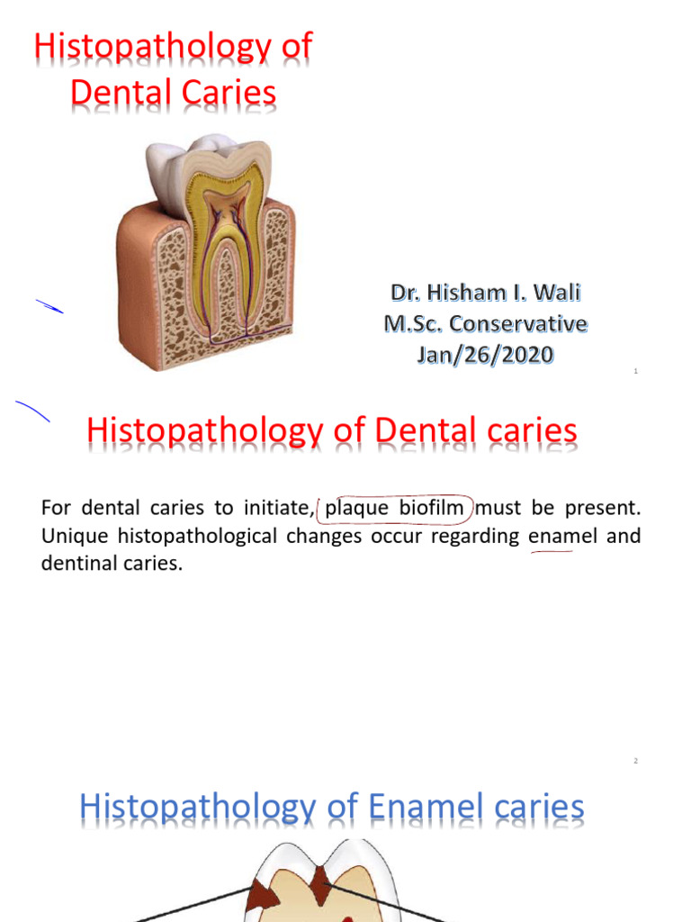 10 Histopathology of Dental Caries | PDF | Dentin | Tooth Enamel