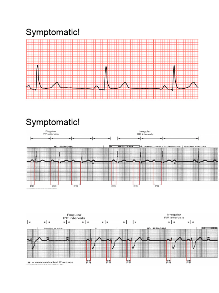 Ecgs For Pacemaker Pres | PDF