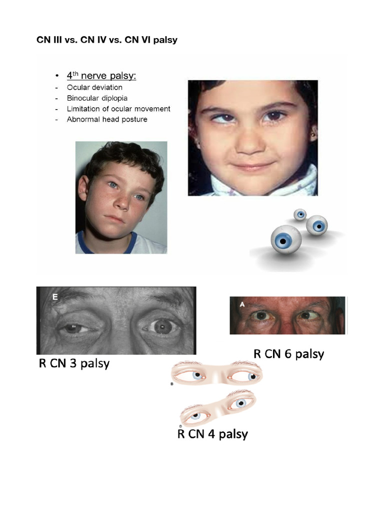 CN Palsies | PDF
