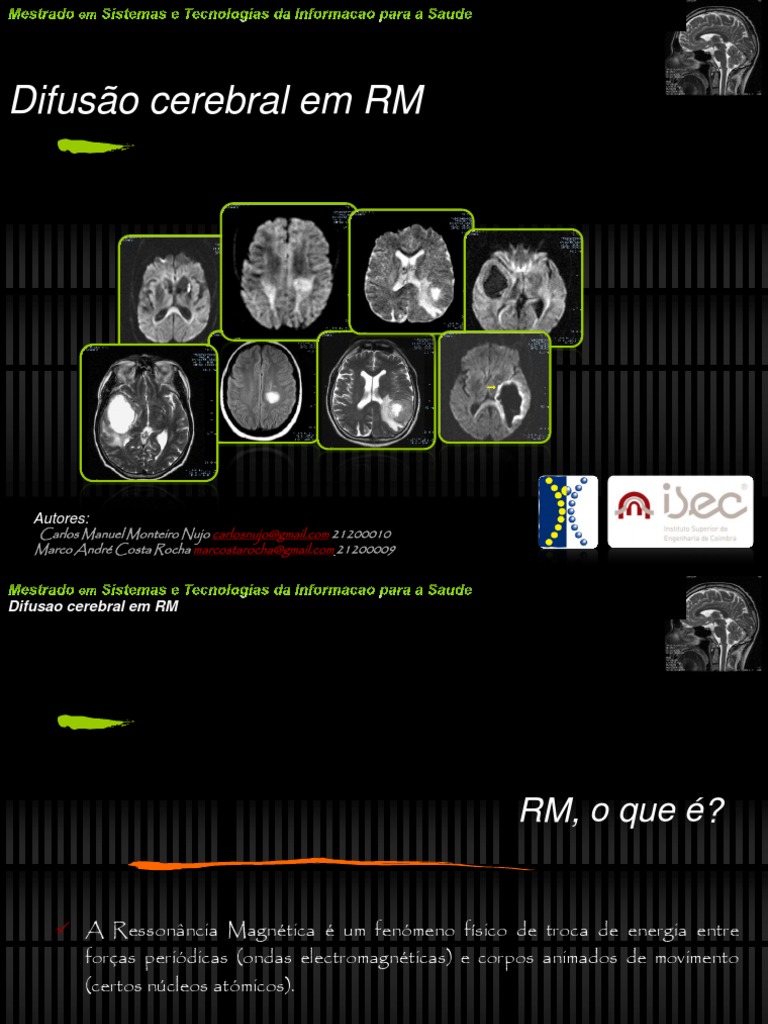 Difusão Cerebral em Ressonância Magnética | PDF | AVC | Esclerose múltipla