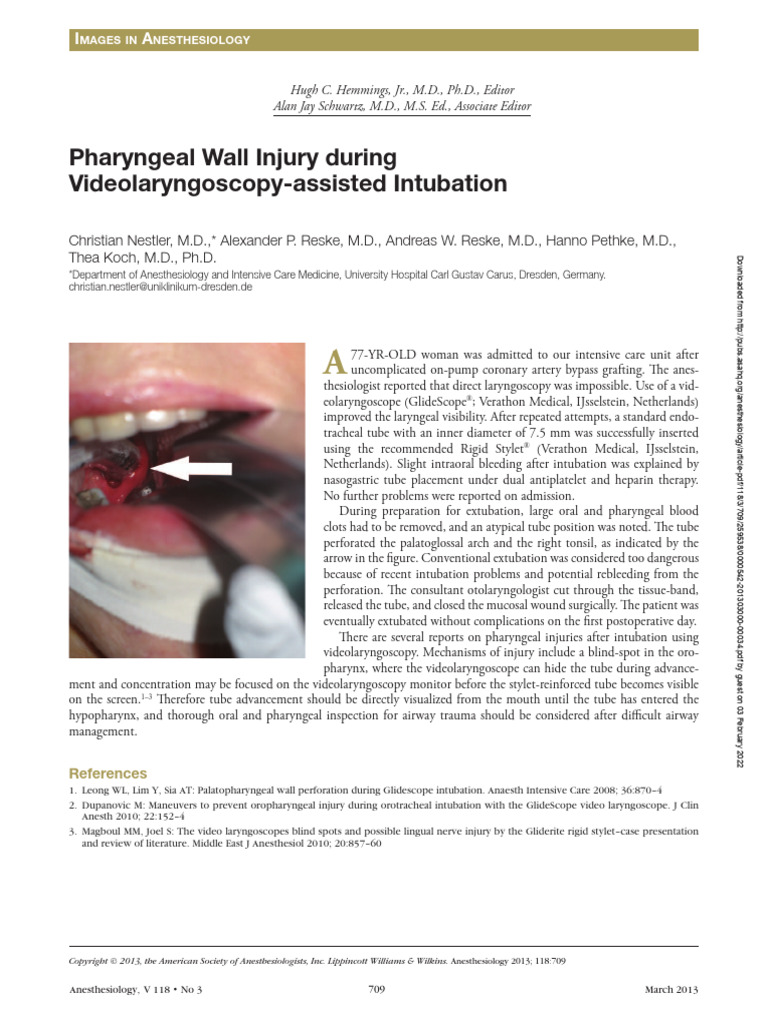 Nestler. Pharyngual Injury During VL Intubation | PDF | Medical ...