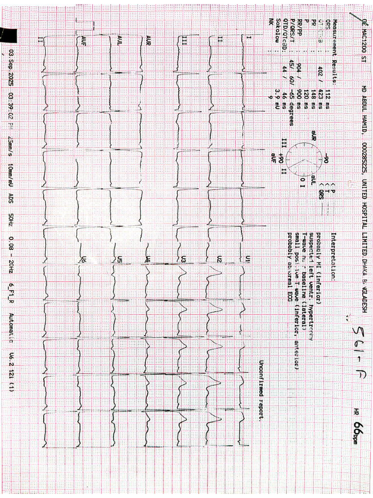 Ecg Scan | PDF