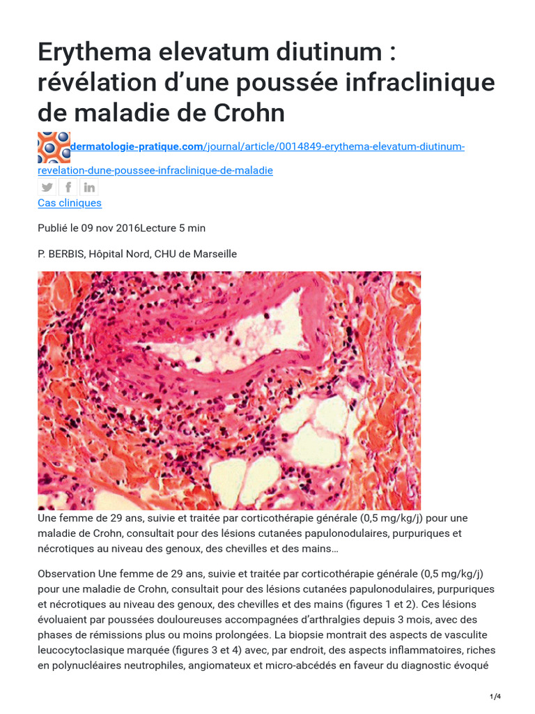Erythema Elevatum Diutinum Révélation Dune Poussée Infraclinique de ...