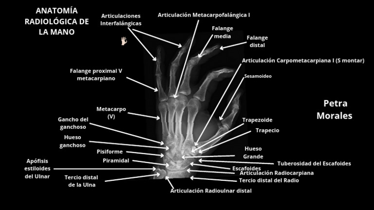 Anatomía Radiológica de La Mano PDF (2) | PDF