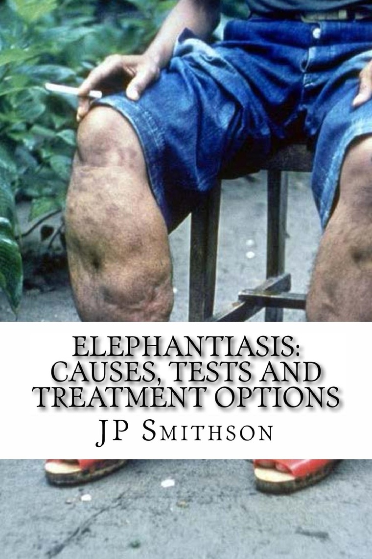 Elephantiasis Causes Symptoms And Treatment - vrogue.co