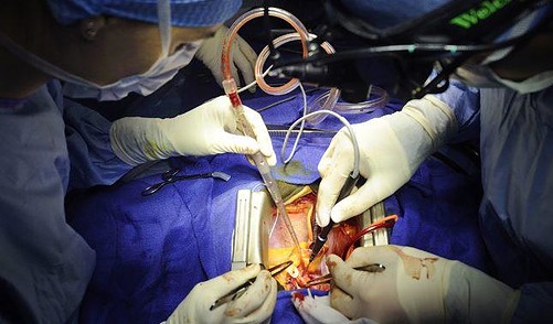 Newer Method of OpenHeart Surgery Carries More Risks
