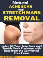 Natural Acne Scar and Stretch Mark Removal: Solve All Your Acne Scar and Stretch Mark Problems with Ease from the Comfort of Your Home