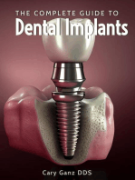 The Complete Guide to Dental Implants: All About Dentistry